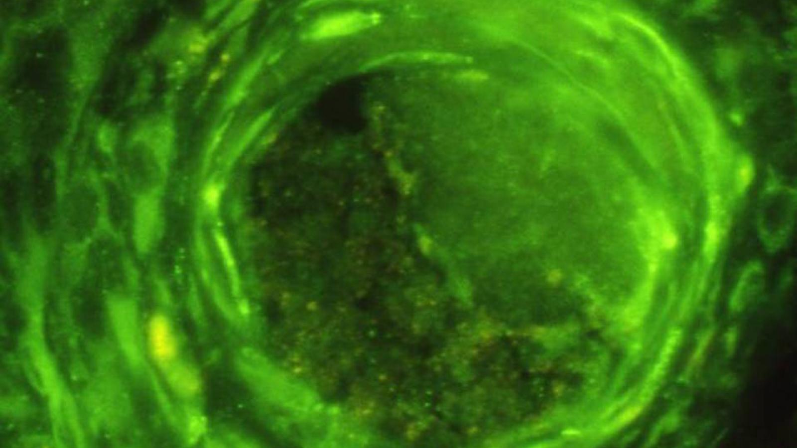 The Truth About Lyme Disease and Chronic Symptoms