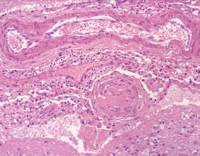 Lyme versus TBE: De belangrijkste verschillen